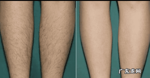 激光冰点脱毛能永久去除吗 激光脱毛最好季节