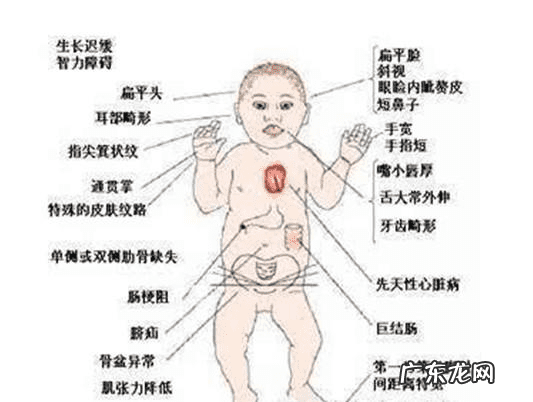 为什么叫唐氏综合症这个名字 唐氏综合症是什么意思