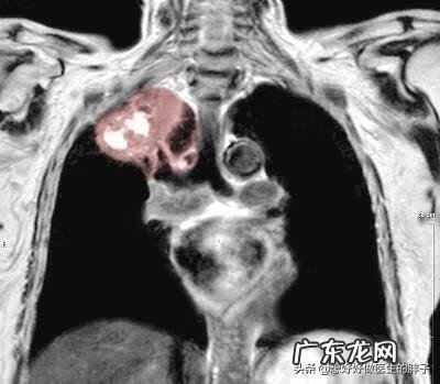 左肩胛骨疼痛是什么原因 左肩膀疼痛是什么原因引起的