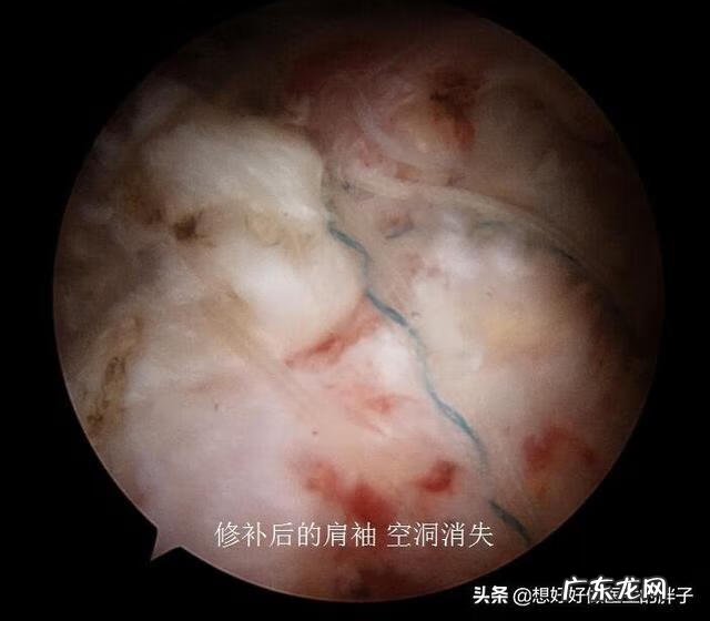 左肩胛骨疼痛是什么原因 左肩膀疼痛是什么原因引起的