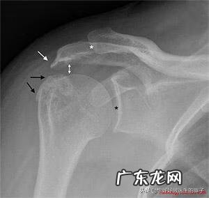 左肩胛骨疼痛是什么原因 左肩膀疼痛是什么原因引起的