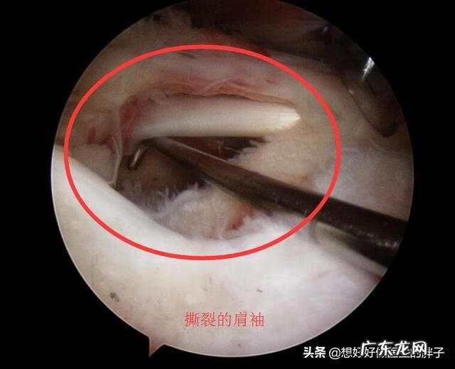 左肩胛骨疼痛是什么原因 左肩膀疼痛是什么原因引起的