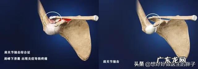 左肩胛骨疼痛是什么原因 左肩膀疼痛是什么原因引起的