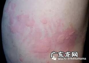 划痕性荨麻疹怎样引起的 划痕性荨麻疹