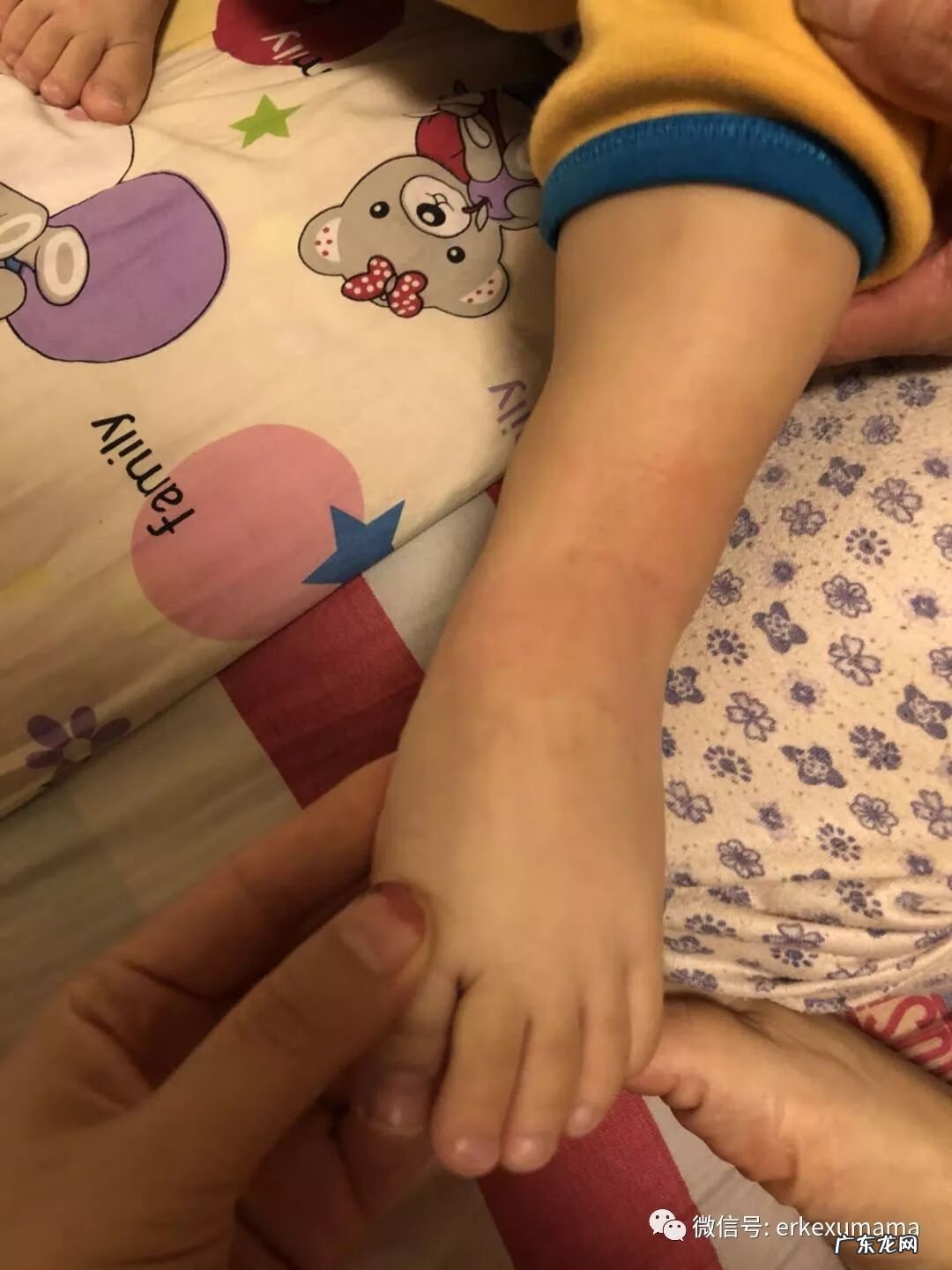 划痕性荨麻疹怎样引起的 划痕性荨麻疹