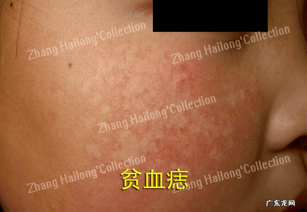 贫血痣一般在什么部位 贫血痣图片