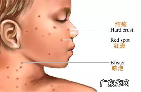 与水痘病人接触后多久被传染 水痘传染期是什么时候开始算