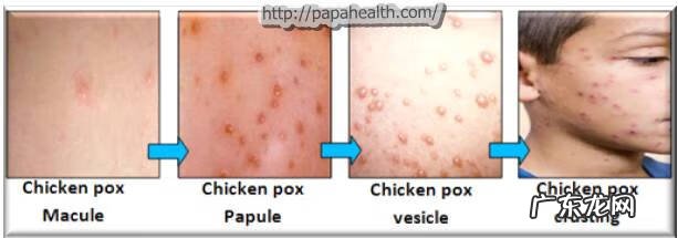 与水痘病人接触后多久被传染 水痘传染期是什么时候开始算