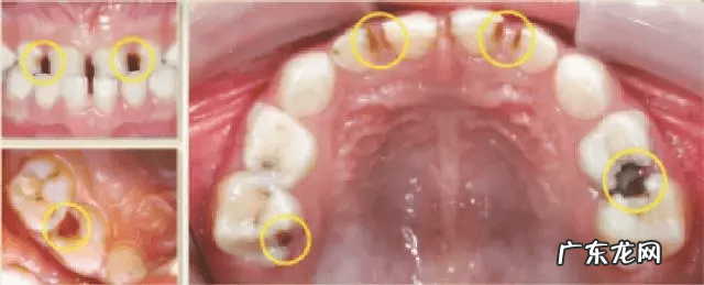 乳牙龋齿是什么意思