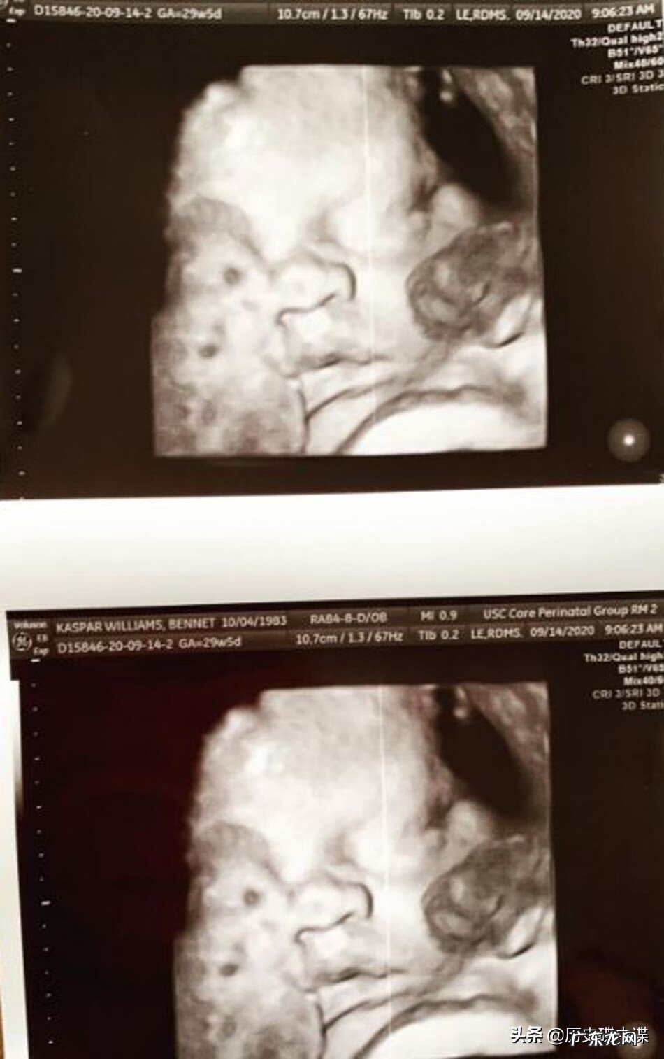 男生变性后可以生小孩吗 变性后能生孩子吗图