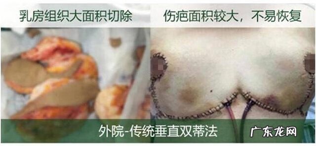 乳房下垂是什么原因 乳头下垂是什么原因造成的
