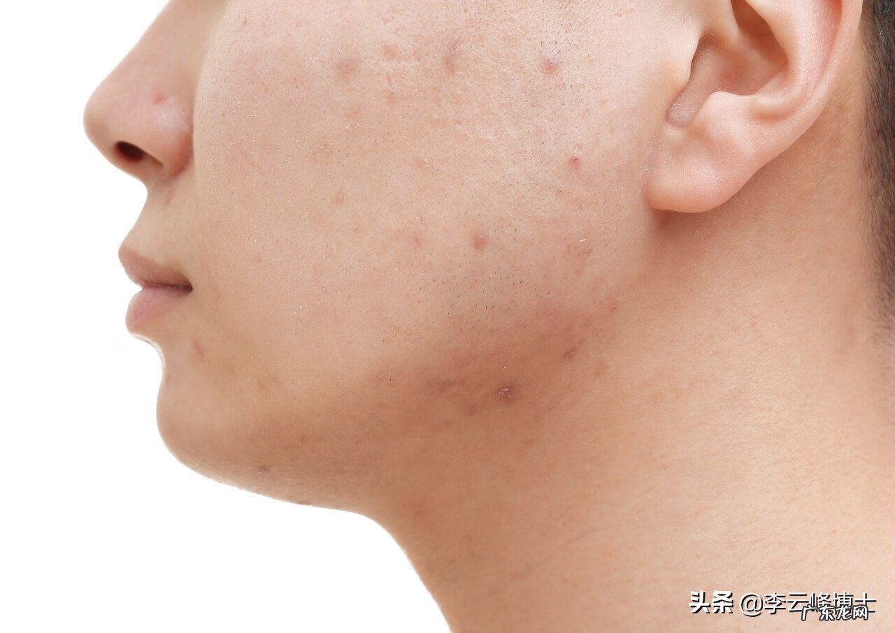 皮炎如何治 激素皮炎的治疗