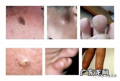 皮下囊肿是怎么回事 皮下囊肿图片