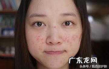 去除痘印的日常方法 去除痘印的办法