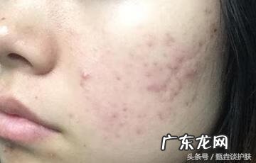 去除痘印的日常方法 去除痘印的办法