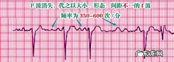 心电图详细图解 心电图怎么看图解