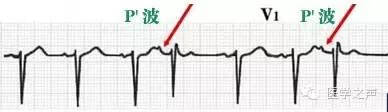 心电图详细图解 心电图怎么看图解