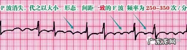 心电图详细图解 心电图怎么看图解