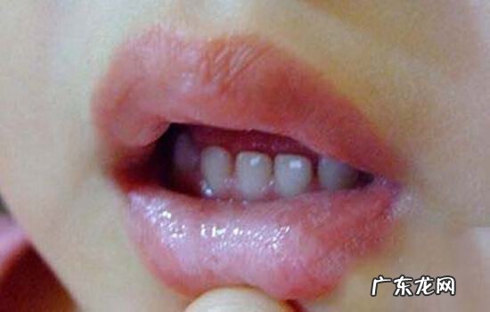 宝宝鹅口疮怎么办 小儿鹅口疮的症状