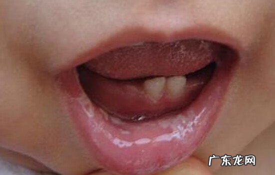 宝宝鹅口疮怎么办 小儿鹅口疮的症状