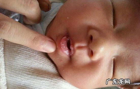 宝宝鹅口疮怎么办 小儿鹅口疮的症状