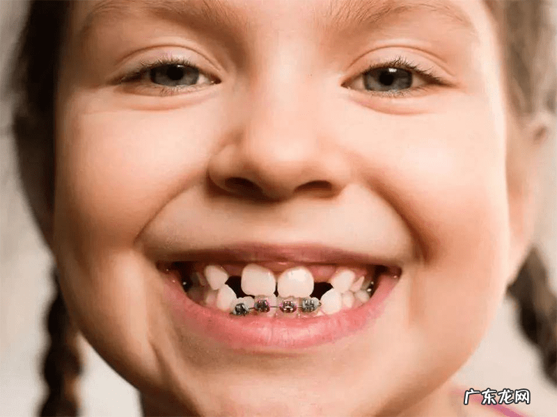 20岁地包天矫正多少钱 地包天矫正多少钱