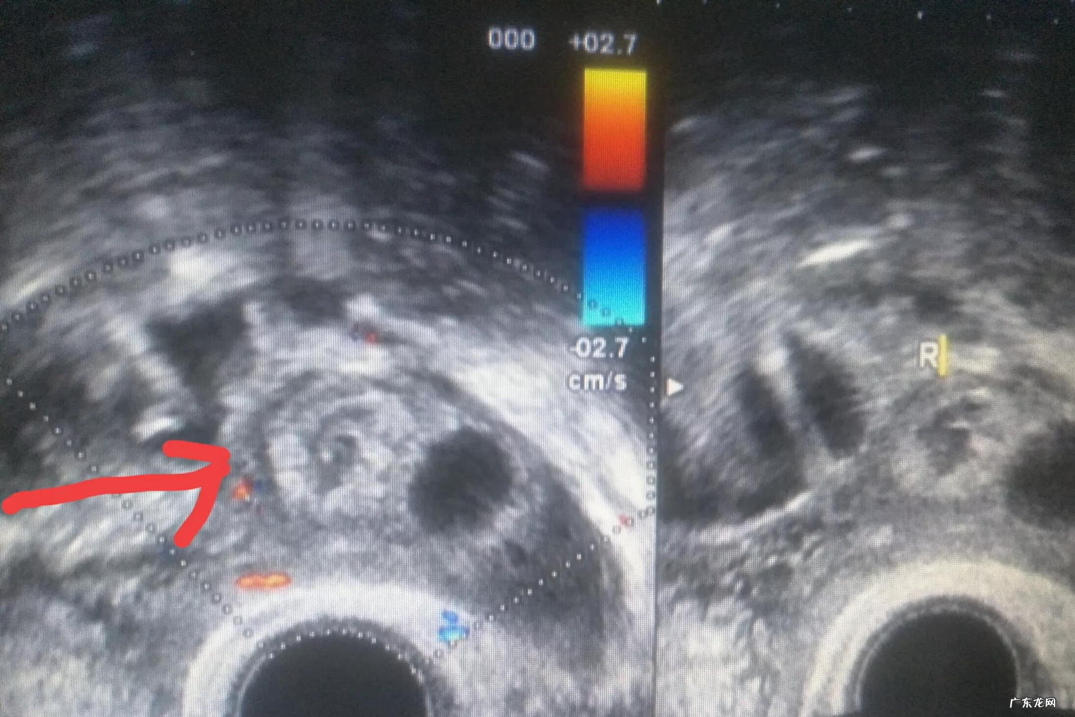 怀孕42天孕囊还在卵巢 卵巢妊娠手术后还能正常怀孕吗