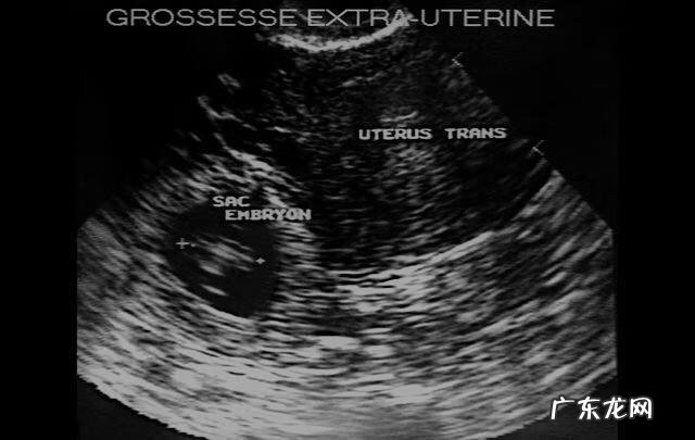 宫外孕最明显的征兆 宫外孕是什么原因造成的