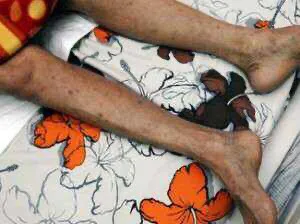 感染艾滋病初期症状图片 艾滋病早期的症状图片