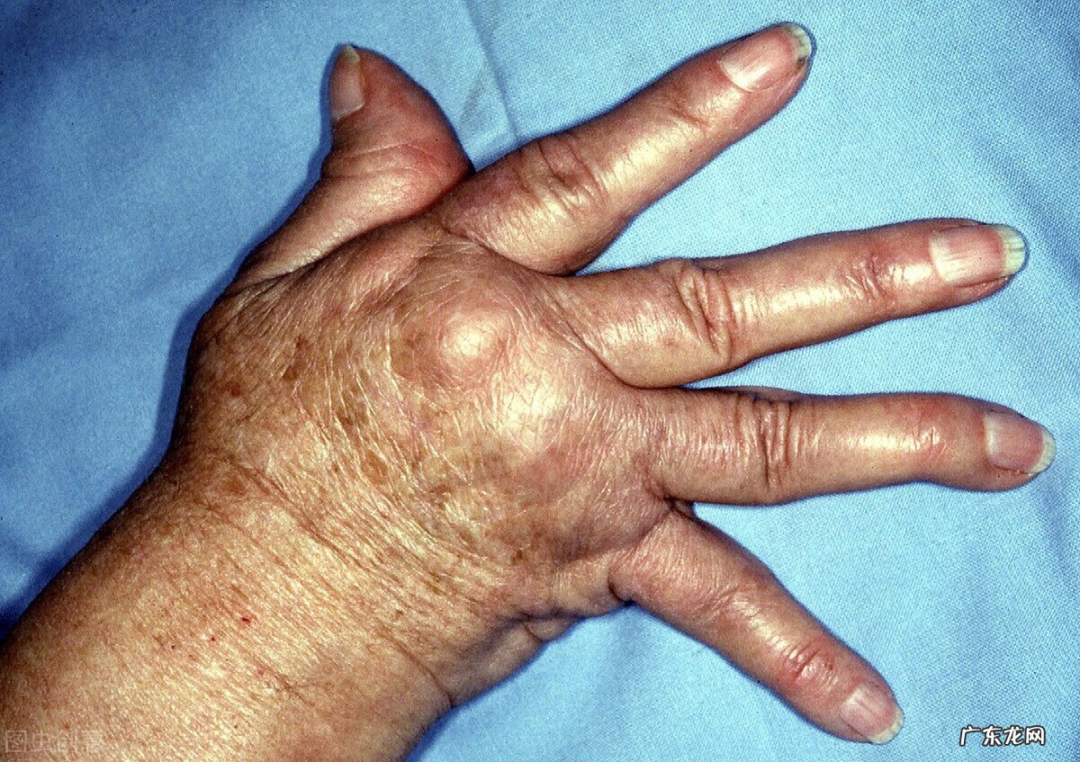 类风湿首选治疗方法 类风湿治疗哪家医院好