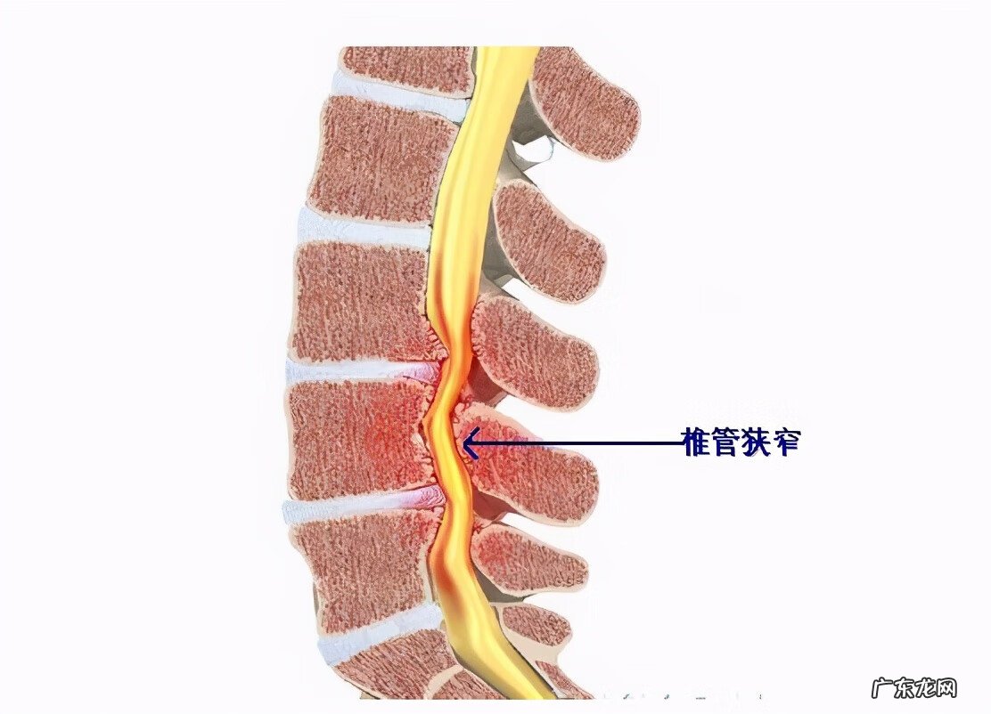 腰间盘突出脊椎管狭窄 腰椎间盘突出和腰椎狭窄