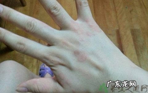 小儿麻疹是怎么引起的 小儿寻麻疹注意事项