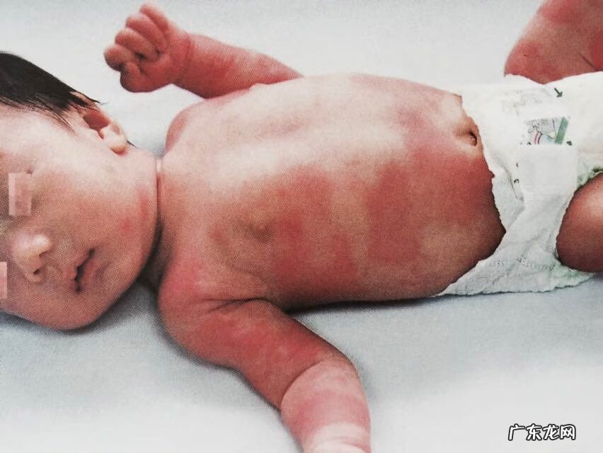 小儿麻疹是怎么引起的 小儿寻麻疹注意事项