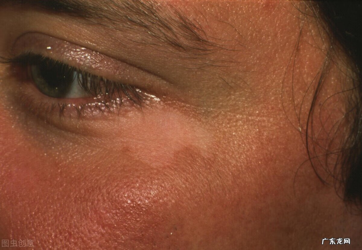 长白斑会传染吗 白颠疯病传染吗