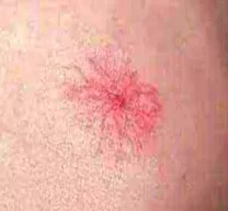 肉痣是怎么形成的 肉痣的风水