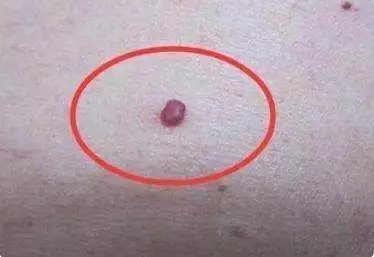 肉痣是怎么形成的 肉痣的风水