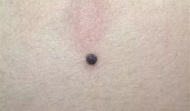 肉痣是怎么形成的 肉痣的风水