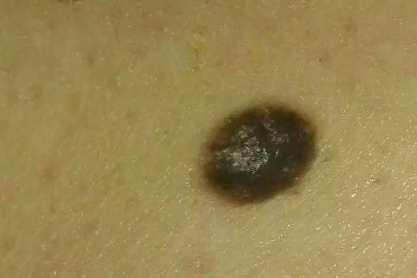 肉痣是怎么形成的 肉痣的风水