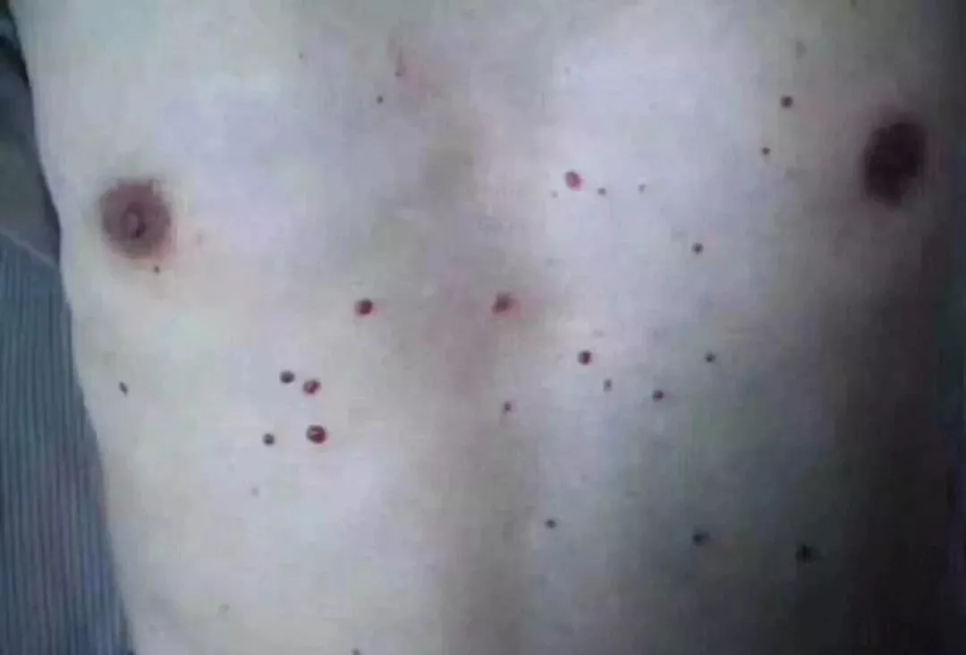 肉痣是怎么形成的 肉痣的风水