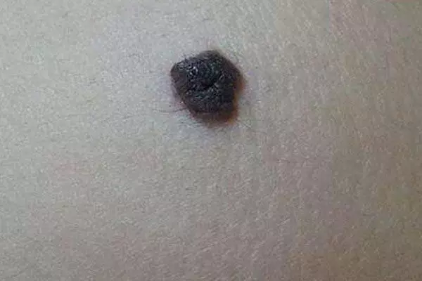 肉痣是怎么形成的 肉痣的风水