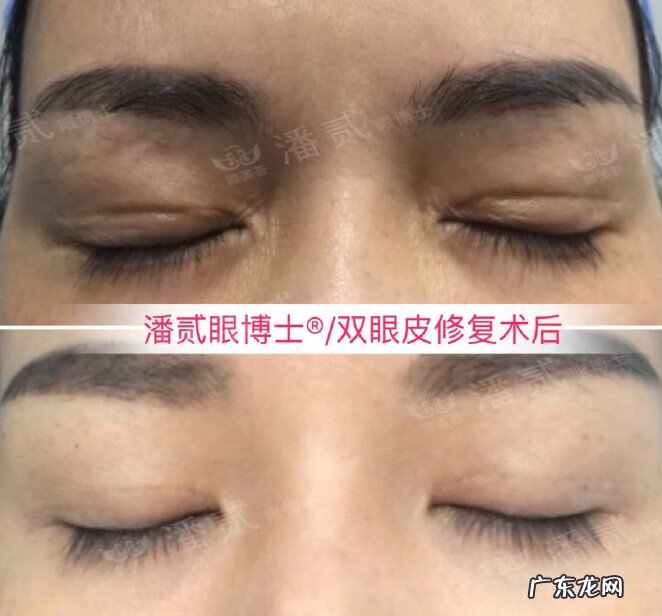 全脸整形需要多少钱 脸部整容费用