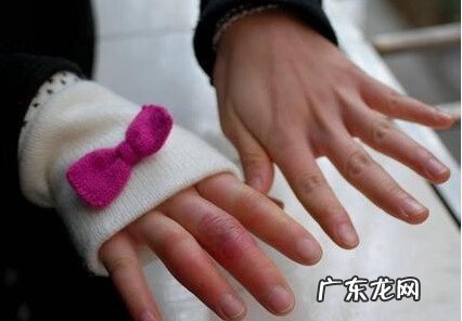 手生冻疮了有什么办法让它好起来 手生冻疮怎么办?