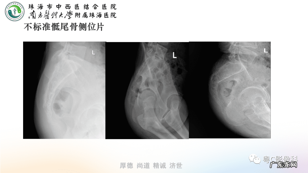 后侧体位展示 后侧位体视频