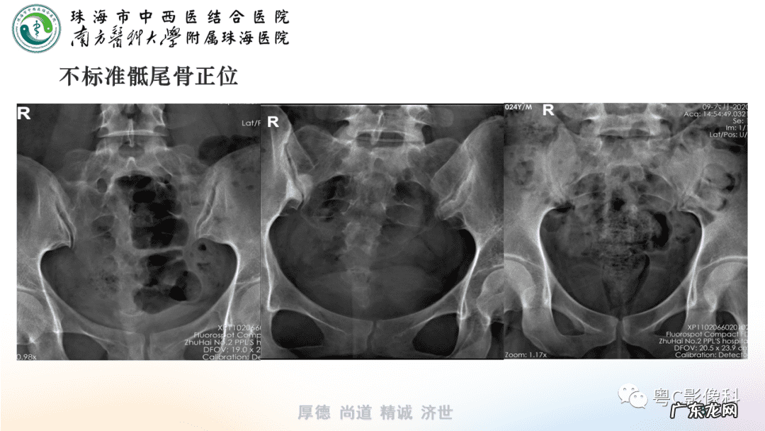 后侧体位展示 后侧位体视频