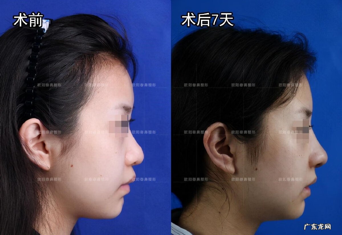 做什么动作可以让鼻子变小 鼻子大怎么变小