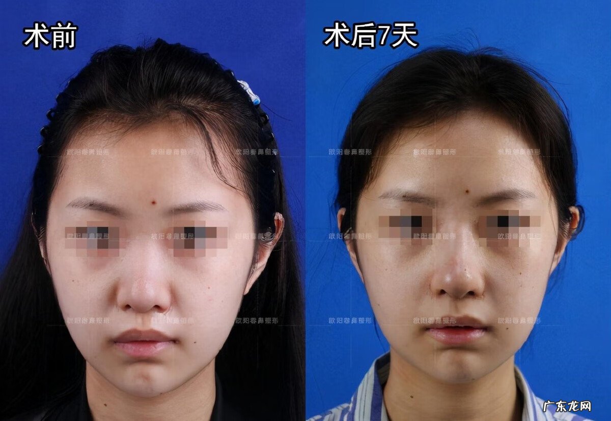 做什么动作可以让鼻子变小 鼻子大怎么变小