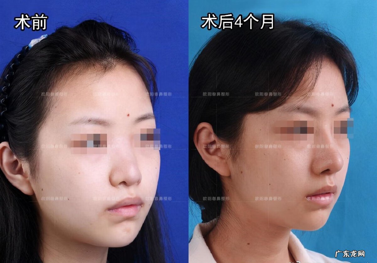 做什么动作可以让鼻子变小 鼻子大怎么变小