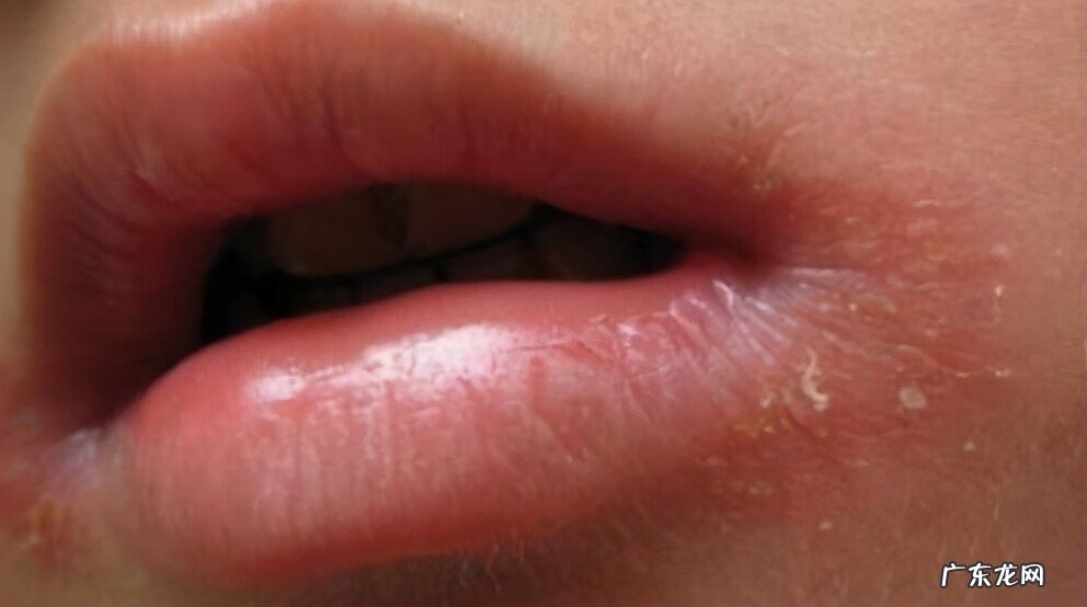 嘴角烂了是什么原因 两边嘴角烂了怎么办