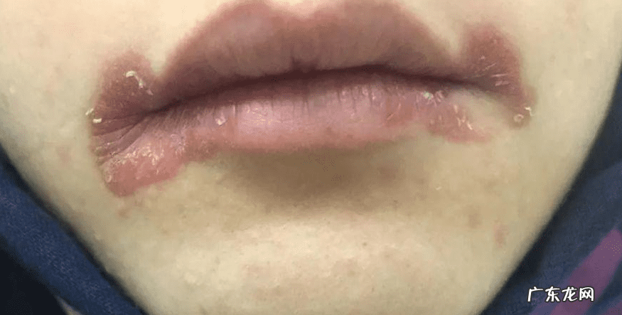 嘴角烂了是什么原因 两边嘴角烂了怎么办