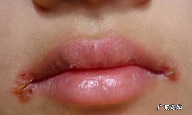 嘴角烂了是什么原因 两边嘴角烂了怎么办